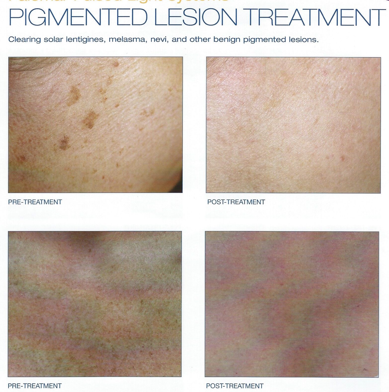 Melasma Brown Spots Treatments Chevy Chase Cosmetic Center